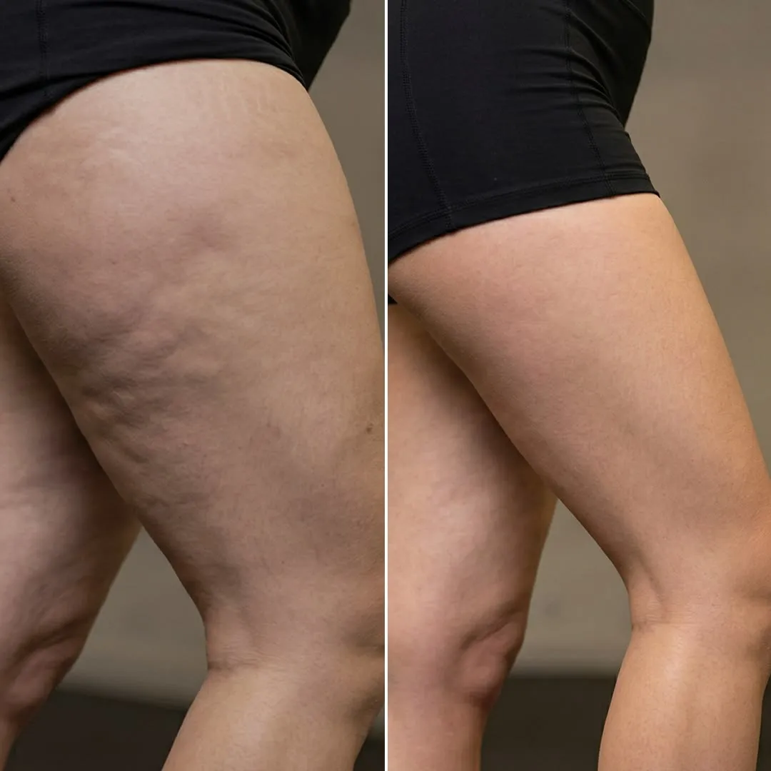 Cellulite Reduction Treatment at Kandyan Aesthetics in Kandy and Kadawatha, Sri Lanka