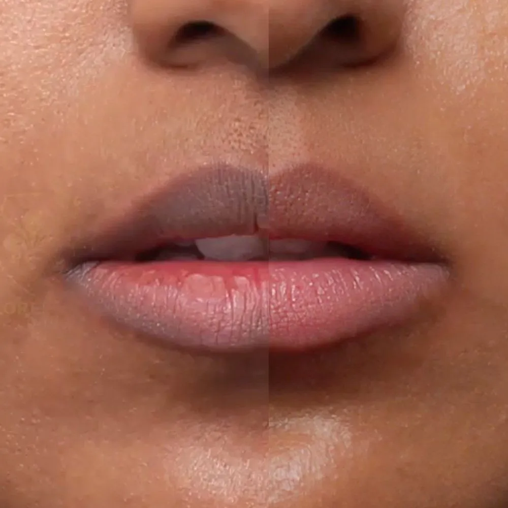 Treatment for Dark Lips at Kandyan Aesthetics in Kandy and Kadawatha, Sri Lanka
