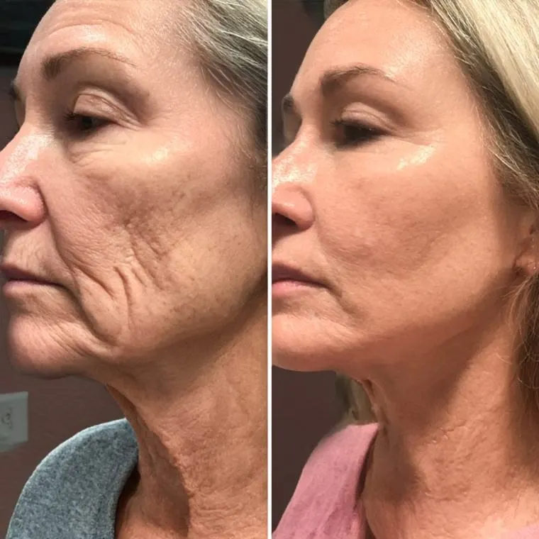 Full Face + Double Chin + Under Eyes + Neck at Kandyan Aesthetics in Kandy and Kadawatha, Sri Lanka