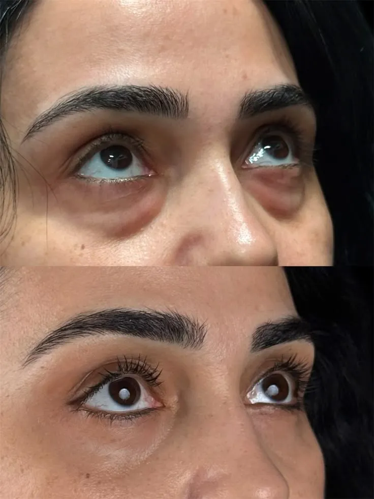 22D Max HIFU non-surgical face and body lifting at Kandyan Aesthetics in Kandy and Kadawatha, Sri Lanka