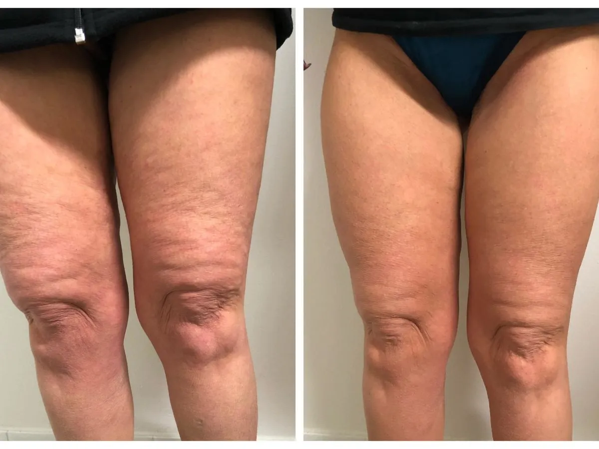 Inner Thigh at Kandyan Aesthetics in Kandy and Kadawatha, Sri Lanka