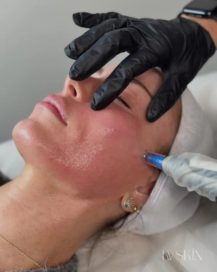 Collagen Induction Therapy at Kandyan Aesthetics in Kandy and Kadawatha, Sri Lanka