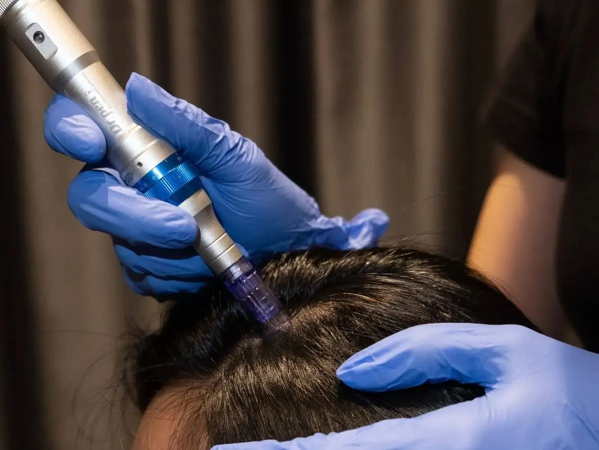 Hair Regrowth Treatment at Kandyan Aesthetics in Kandy and Kadawatha, Sri Lanka
